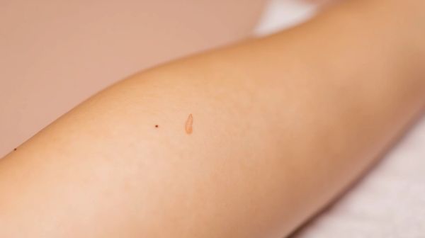 Épilation laser à La Rochelle : une peau lisse et sans poils